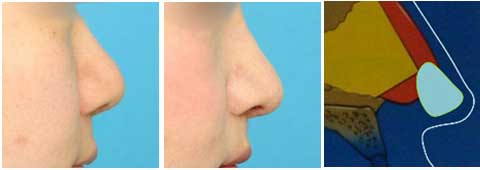 使用幅度宽的板状软骨，鼻头和鼻小柱都可以向下延伸