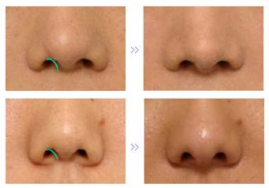 鼻中隔延长术的观察结果 (写真P)