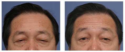 眼睑下垂患者总是努力地使用额肌向上提起的。