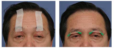 患者在被模拟的过程中，可以体验到因为遮挡住黑眼珠的上眼皮被吊起来了，不快的症状减轻了