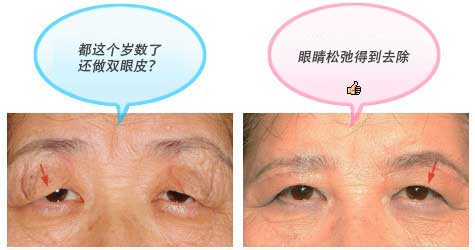 另外，对于本身是单眼皮但是不想变成双眼皮的患者来讲，这个手术也值得推荐。