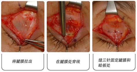 眼睑下垂：腱膜前徙手术