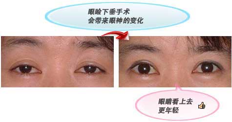 眼睑下垂手术会带来眼神的变化