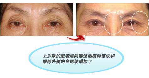 上岁数的患者眉间部位的横向皱纹和眼部外侧的鱼尾纹增加了