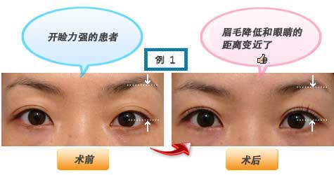 开睑力强的患者 眉毛降低和眼睛的距离变近了
