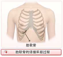 胸の肋骨の内側の部分にある肋軟骨の採取