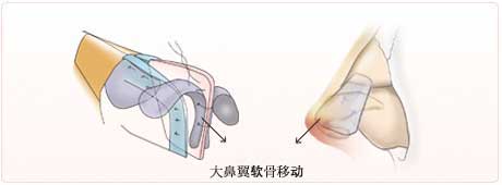 鼻中隔软骨的前端与（移植）软骨相缝合，大鼻翼软骨移动