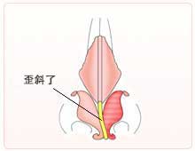 鼻的变形