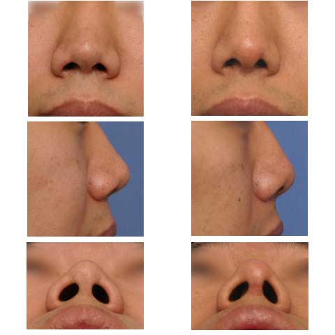 使用两枚耳软骨实施鼻中隔延长，长度还是不够。