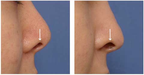 鼻头向下延伸鼻孔容易被看见的例子 症例1