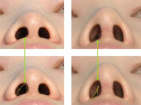 术后常见问题「鼻塞」 症例1