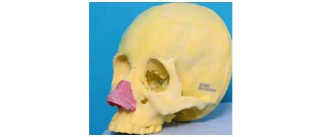 这个患者的头盖骨模型和患者本人的真实的骨骼的误差在1毫米以下。