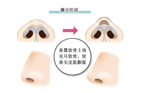 与鼻中隔延长术的比较