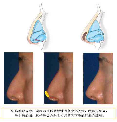 鼻先を高くするため鼻尖形成プラス鼻中隔を短�sして鼻先を持ち上げる　症例1
