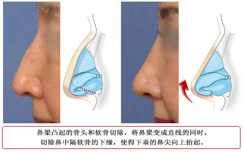 鼻先を高くするため鼻尖形成プラス鼻中隔を短�sして鼻先を持ち上げる　症例2
