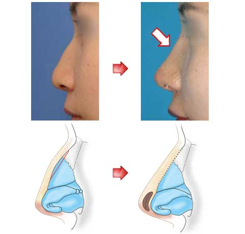 鼻梁的驼峰少量地切除并实施了鼻尖形成手术