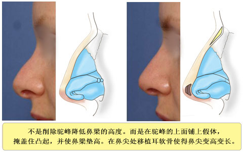 鼻根部和鼻尖部都垫高的 症例 1