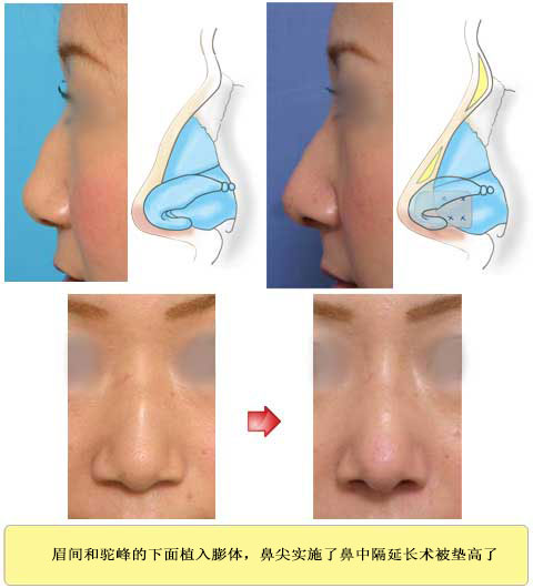 鼻根部和鼻尖都变高的 症例 2