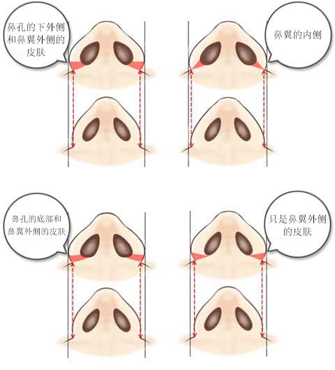 鼻翼外侧的弧线比鼻翼根部向外张开的类型